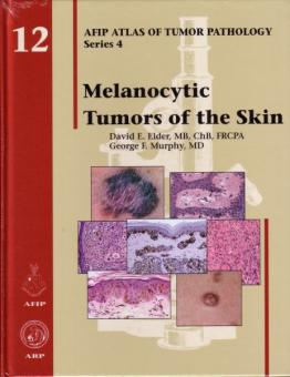 Melanocytic Tumors of the Skin 