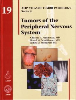 Tumors of the Peripheral Nervous System 