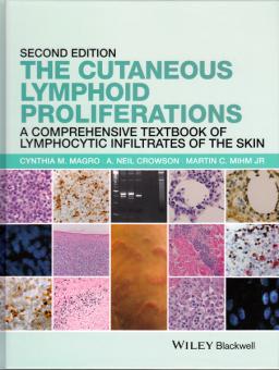 The Cutaneous Lymphoid Proliferations 