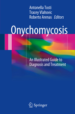Onychomycosis 