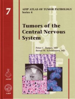 Tumors of the Central Nervous System 