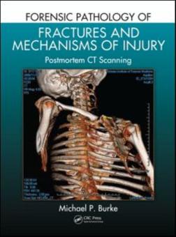 Forensic Pathology of Fractures and Mechanisms of Injury 