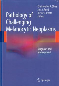 Pathology of Challenging Melanocytic Neoplasms 
