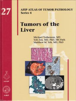 Tumors of the Liver 