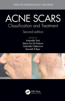 Acne Scars 
