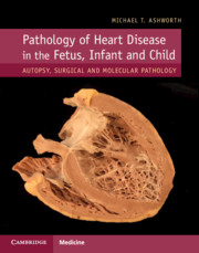 Pathology of Heart Diseases in Fetus, Infant and Child 