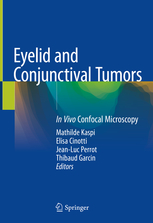 Eyelid and Conjunctival Tumors 