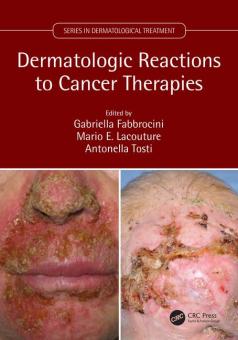 Dermatologic Reactions to Cancer Therapies 
