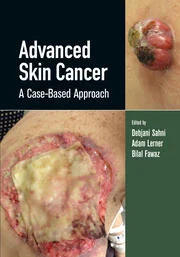 Advanced Skin Cancer 
