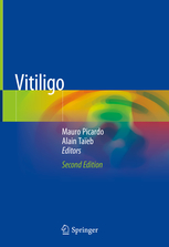 Vitiligo 